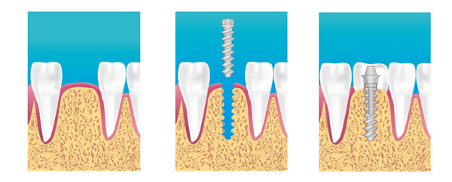 implant dentaire Bruxelles Ixelles